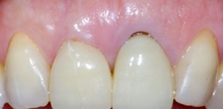 Frattura metallo ceramica e presenza di inestetismo legato alla differente dimensione dei due denti