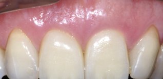 Corone in ceramica integrale