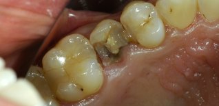 Frattura del secondo premolare superiore