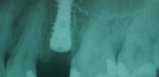 Radiografia impianto post estrattivo