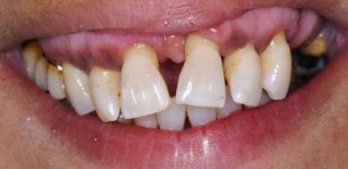 Inestetismo iniziale