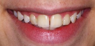 Prima del trattamento