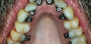 Trattamento ortodontico fisso linguale