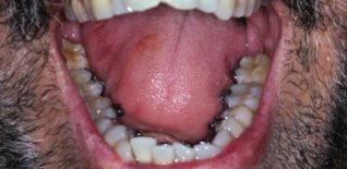 Trattamento ortodontico fisso linguale
