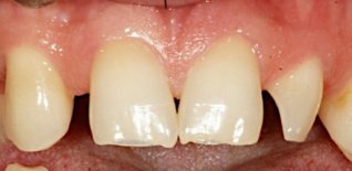 Assenza del laterale destro e laterale sinistro conoide