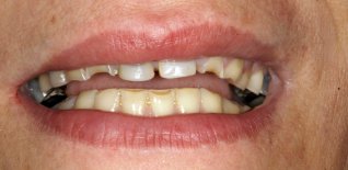 Foto iniziali con forti abrasioni dentali