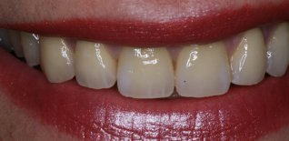 Particolari della riabilitazione estetica