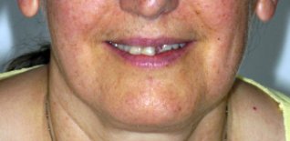 Prima del trattamento