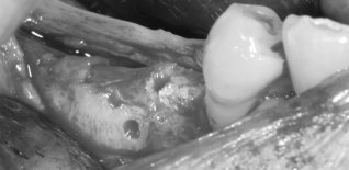 Innesto d'osso in blocco alla riapertura